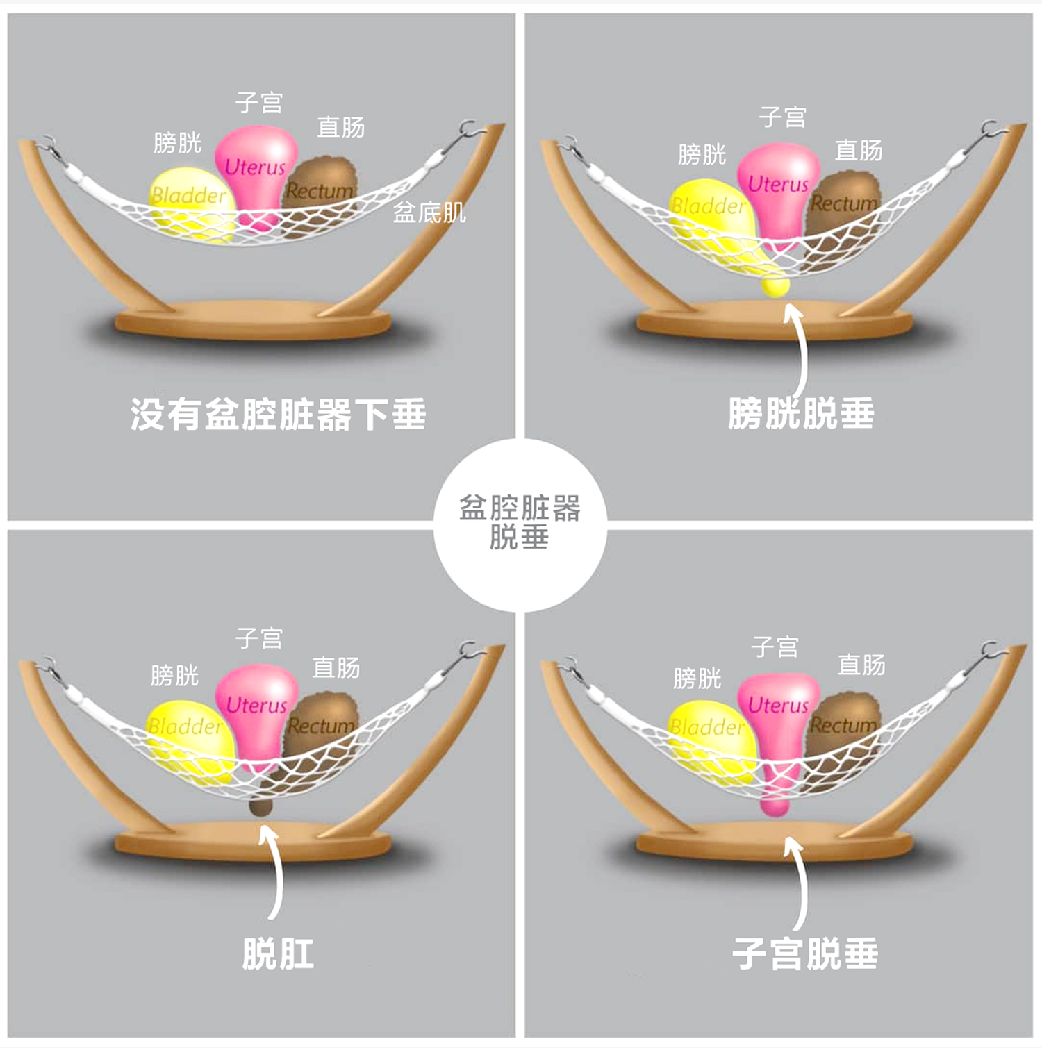 Reparaci&oacute;n de los m&uacute;sculos del suelo p&eacute;lvico (3)